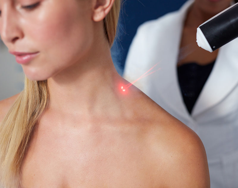 Close-up of woman having laser treatment on her shoulder